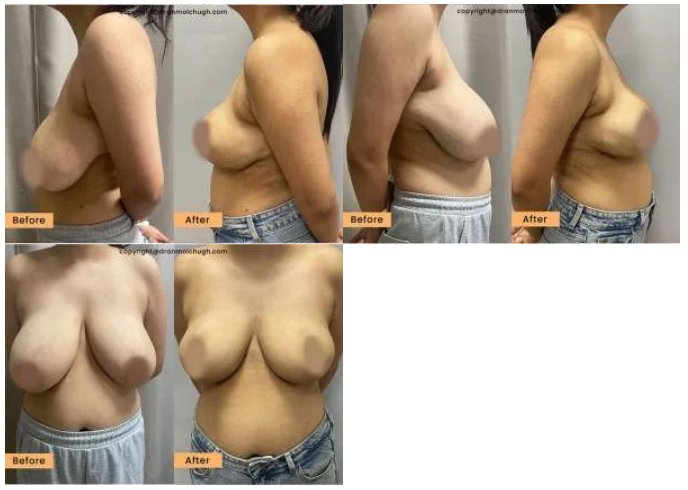 Breast Reduction Surgery for 32 year old lady