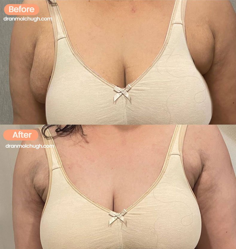 Axillary Breast Reduction