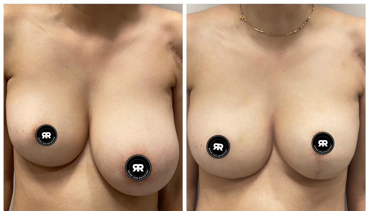 Breast Reduction with liftt