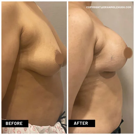 Breast Augmentation with Implants