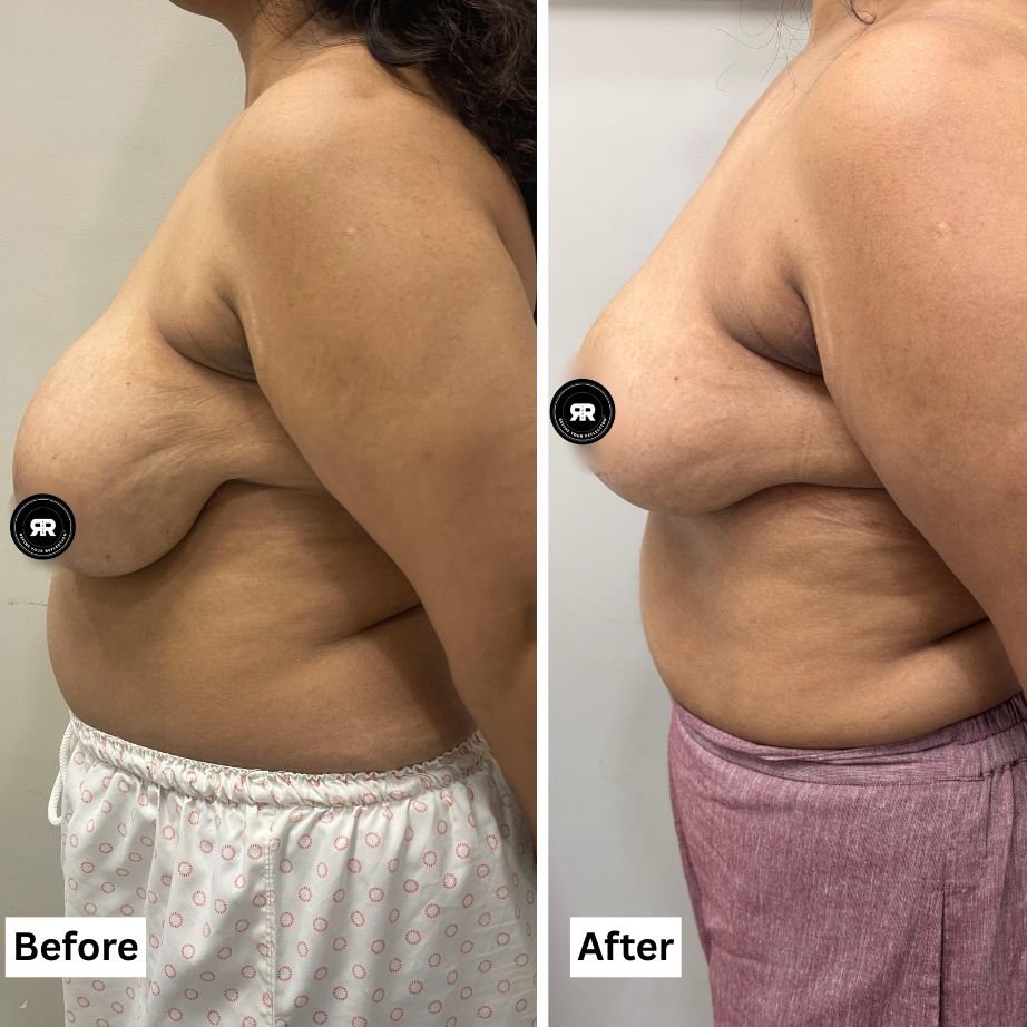 Breast Reduction Before and After Patient Result